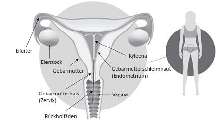 Kyleena in der Gebärmutter