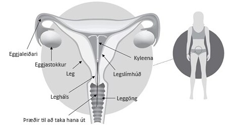 Kyleena í leginu