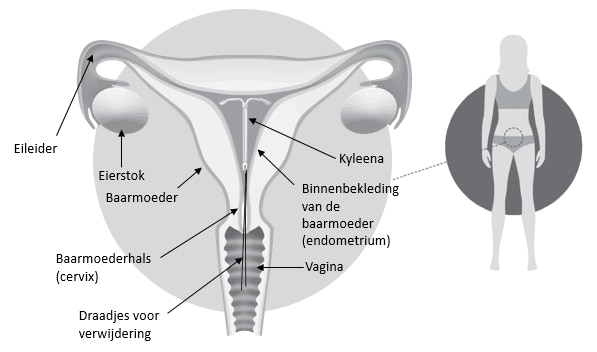 Kyleena in de baarmoeder
