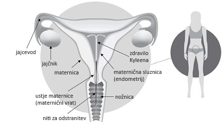 Zdravilo Kyleena v maternici