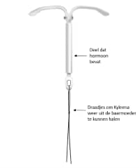 De Kyleena hormoonspiraal