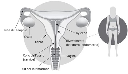 Kyleena all’interno dell’utero